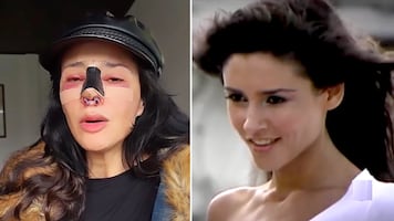 Dorismar enfrenta daños irreversibles tras cirugía estética: amputación parcial de la nariz afecta su respiración