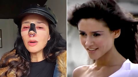 Dorismar enfrenta daños irreversibles tras cirugía estética: amputación parcial de la nariz afecta su respiración