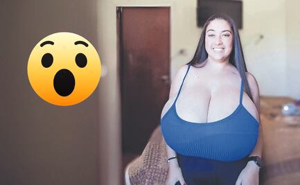 ¿Qué es la gigantomastia y cómo afectó a esta joven?