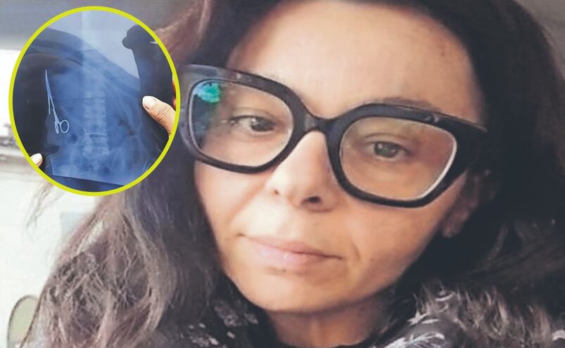 ¿Cómo sobrevivió? La mujer que vivió 5 meses con unas tijeras olvidadas en el abdomen