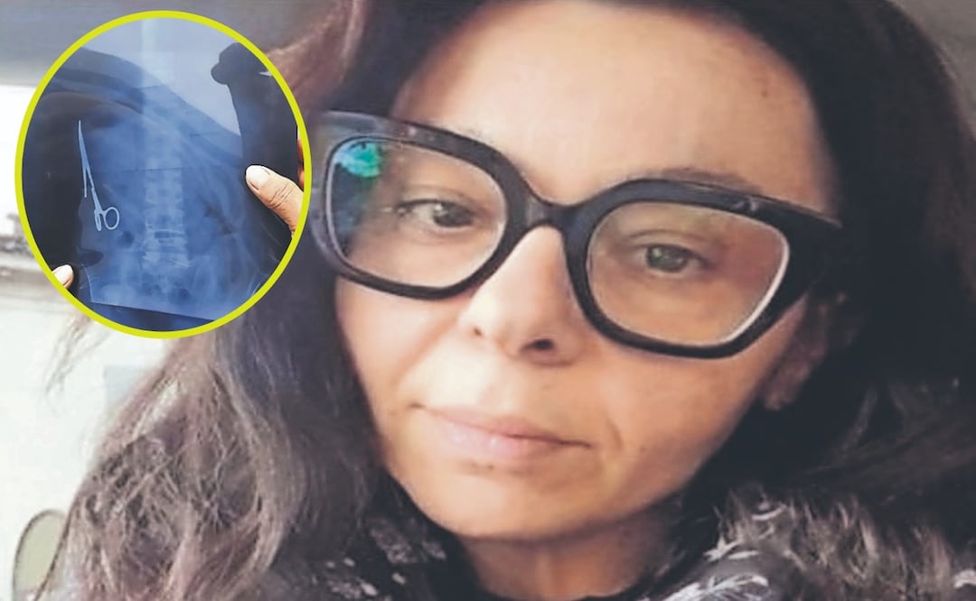 ¿Cómo sobrevivió? La mujer que vivió 5 meses con unas tijeras olvidadas en el abdomen