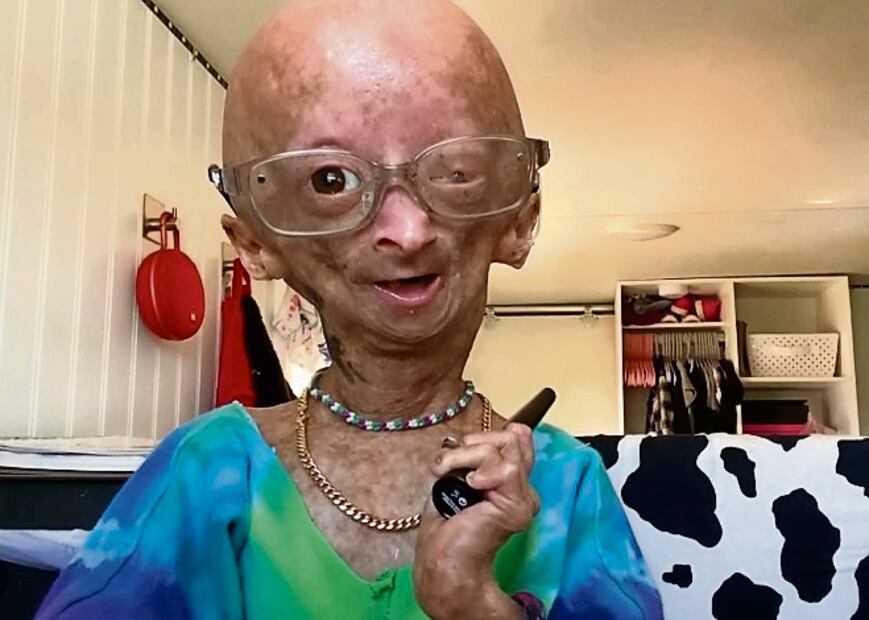 03_progeria_2_164602979.jpg