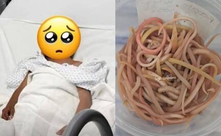 Extraen más de 140 lombrices del cuerpo de un niño ¿Qué son los Ascaris y cómo prevenirlos?