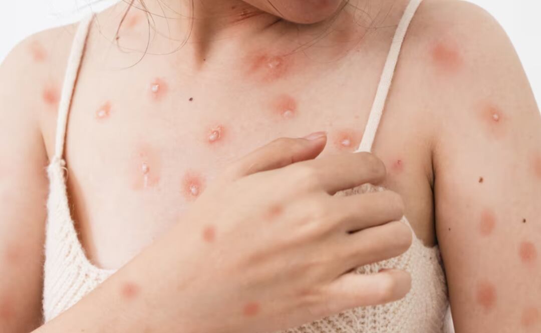 Alertan por variante peligrosa de la viruela del mono en Europa