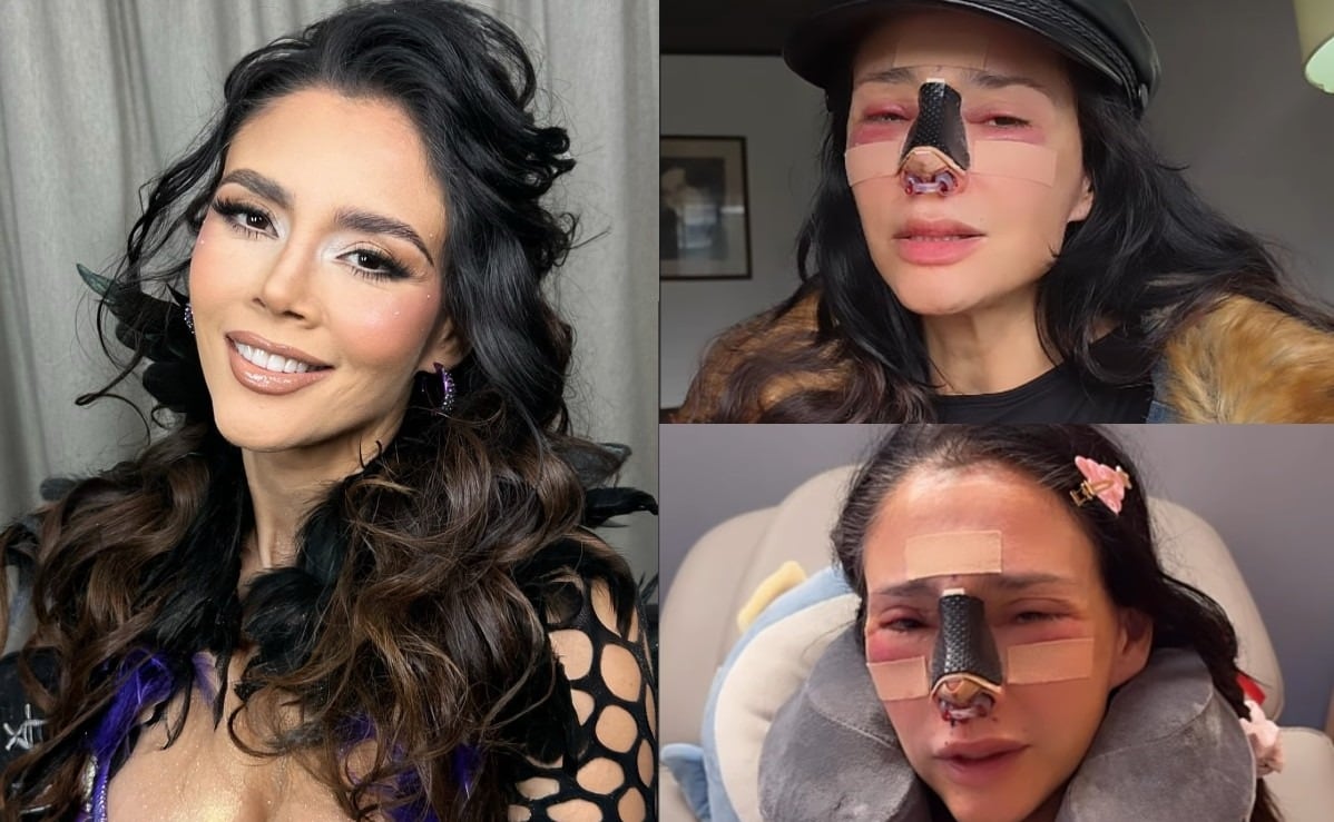 Dorismar viaja hasta Colombia para que le hagan el milagro de recuperar su nariz y rostro