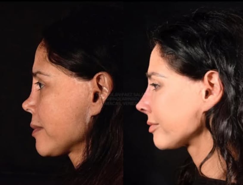 Dorismar, antes y después (Foto: Instagram)