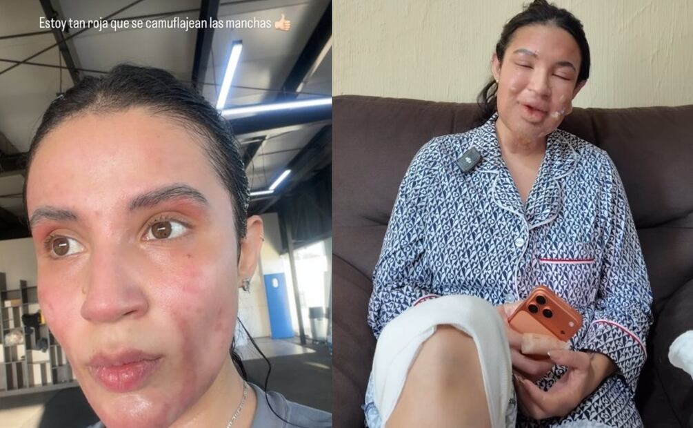 Actriz mexicana muestra la evolución de sus heridas tras explosión por acumulación de gas en su depa
Imagen: Instagram