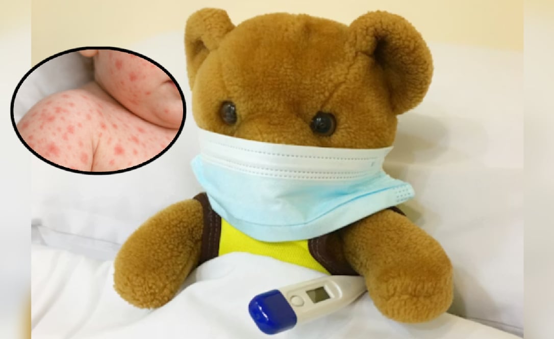 Sarampión, muere bebé en CDMX (Foto: Ilustrativa, creada con IA)