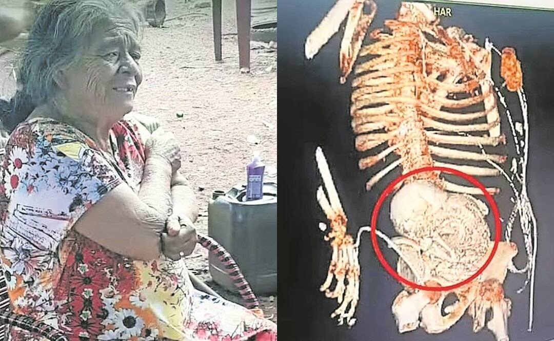 En Brasil una mujer murió por llevar un feto en su vientre por 40 años