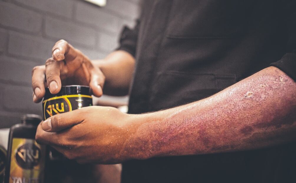 Juan Luis se quemó el brazo en explosión de pipa, sobrevivió y pide que no olviden a las víctimas
Imagen: OSMAR ALVARADO. EL GRÁFICO