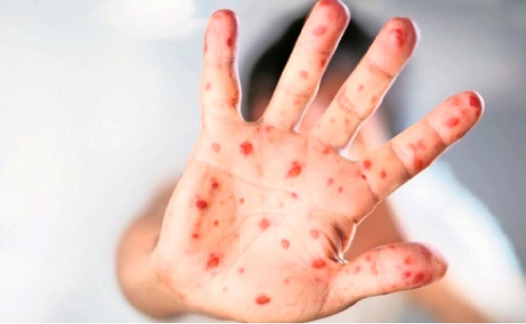 ¡ALERTA! Confirmados 4 mil casos de viruela del mono en México