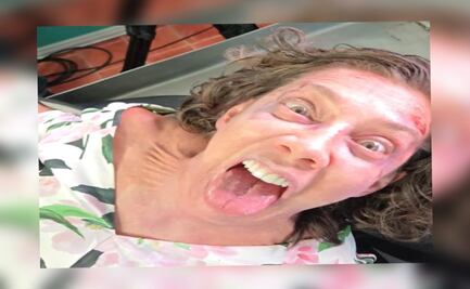 Cynthia Klitbo: este es su estado de salud tras ser picada por peligrosa araña