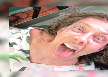 Cynthia Klitbo: este es su estado de salud tras ser picada por peligrosa araña