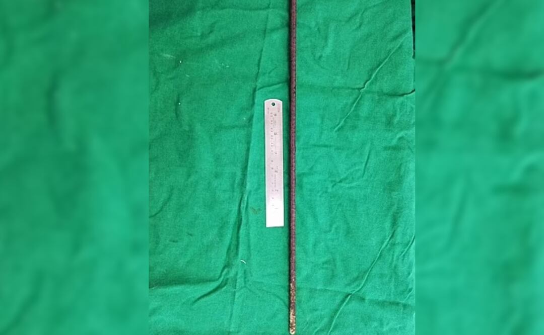 Mujer cae y se entierra varilla de 60 centímetros en el trasero