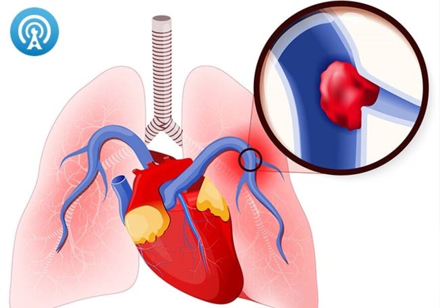 trombosis-pulmonar.jpg