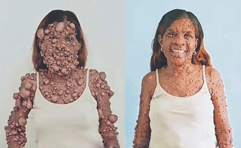 operacion_de_neurofibromatosis.jpg