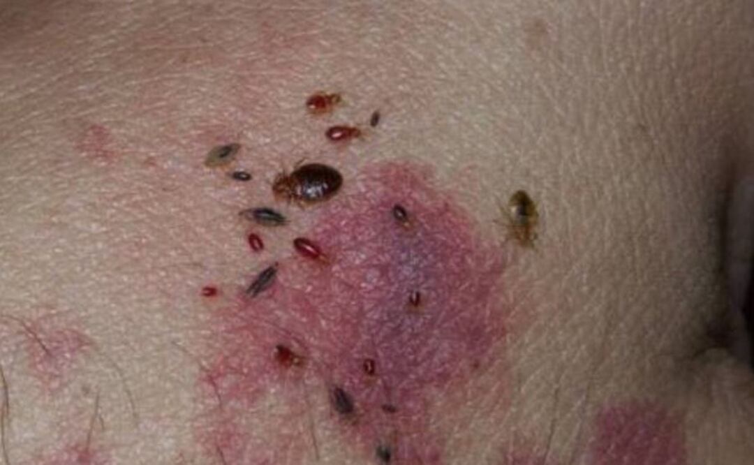 Chinches invaden la UNAM y toda la CDMX, esto debes hacer si las detectas