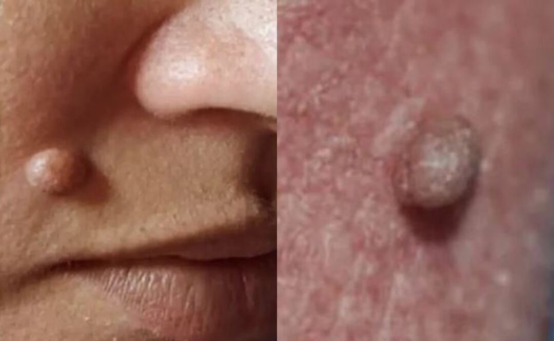 ¿Todas las verrugas son VPH? Te revelamos toda la verdad