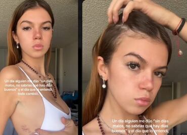 Valentina Gilabert muestra sus cicatrices y lanza mensaje de fuerza tras el ataque de Marianne