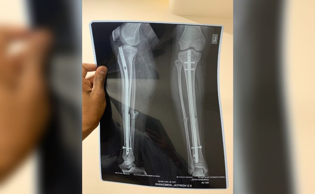 ¡CUIDADO! Fracturas aumentan incapacidades en los mexicanos y ya representan un serio problema