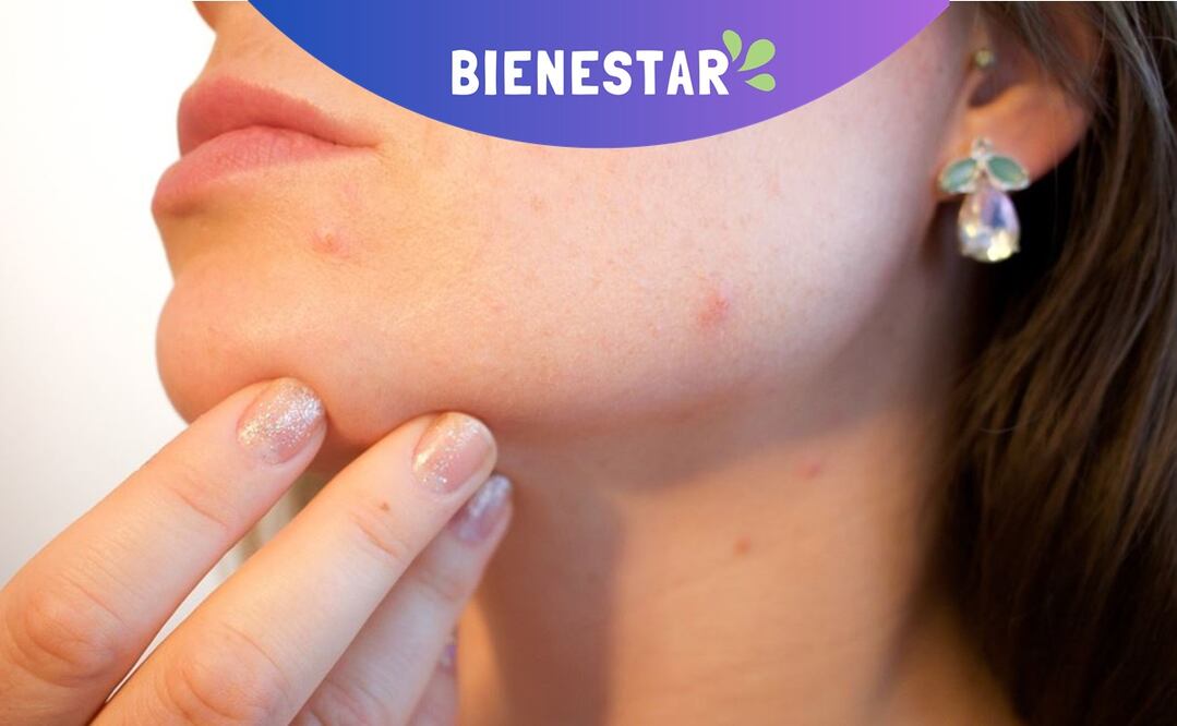 ¡Al grano con las imperfecciones! Guía definitiva para decirle ADIÓS a barros y espinillas