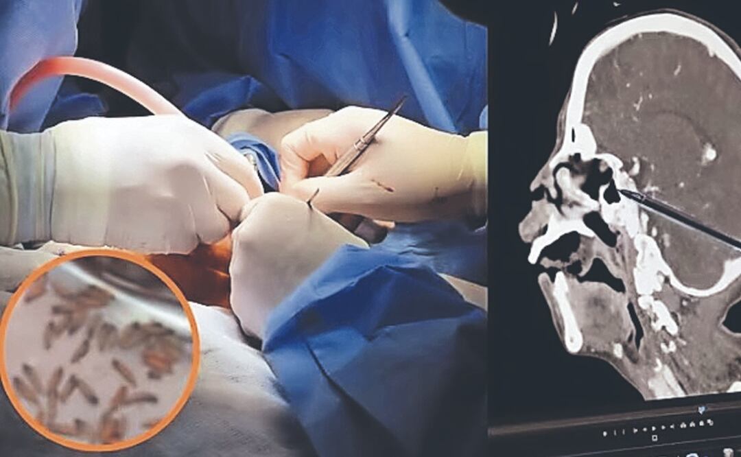 150 gusanos habitaban la boca de una mujer en Perú ¿cómo pasó?