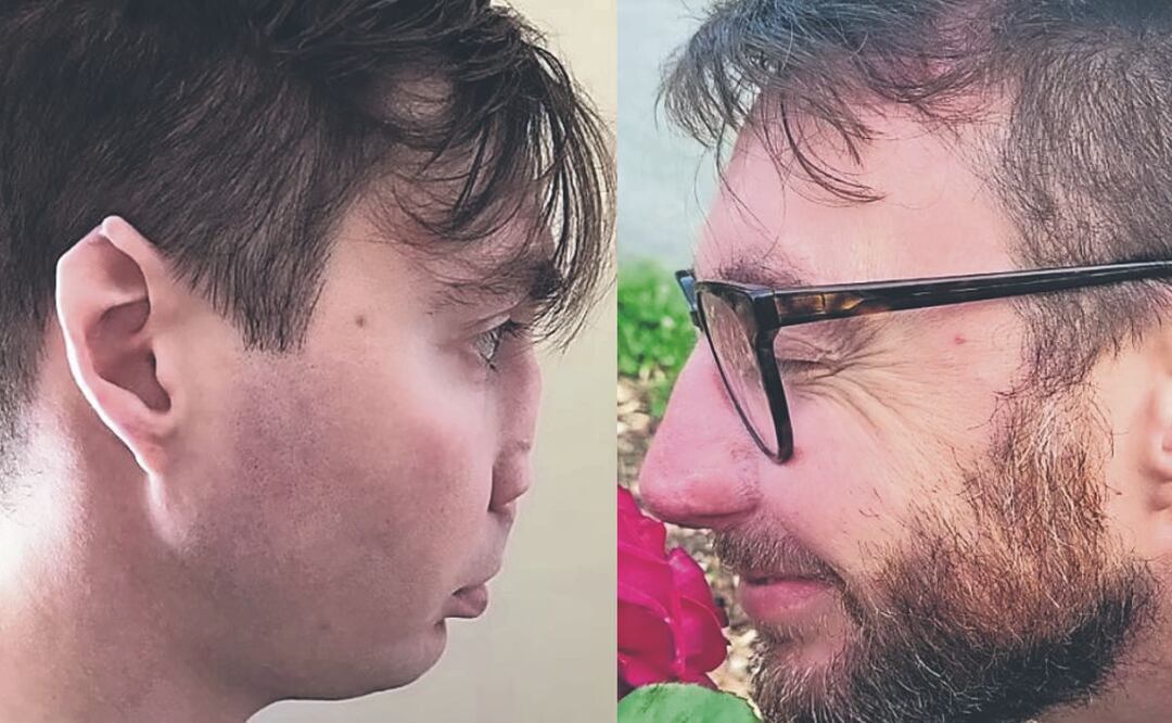 Hombre que parecía Voldemort pudo recuperar su nariz ¿Cómo fue posible?