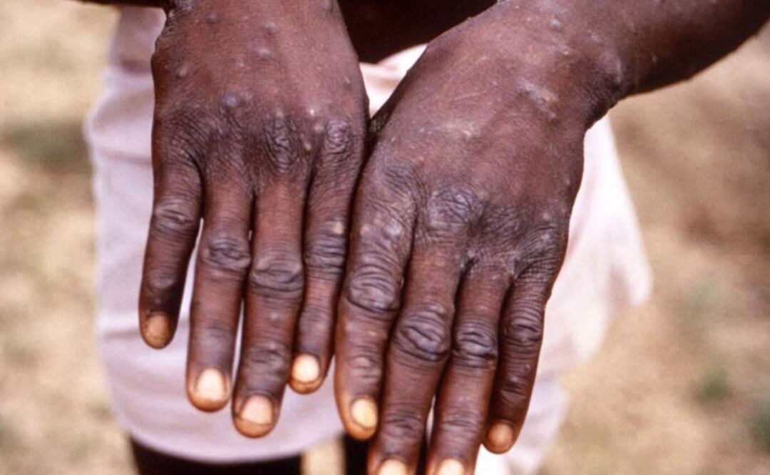 Viruela del mono: Síntomas del mpox y que debes hacer si te contagias