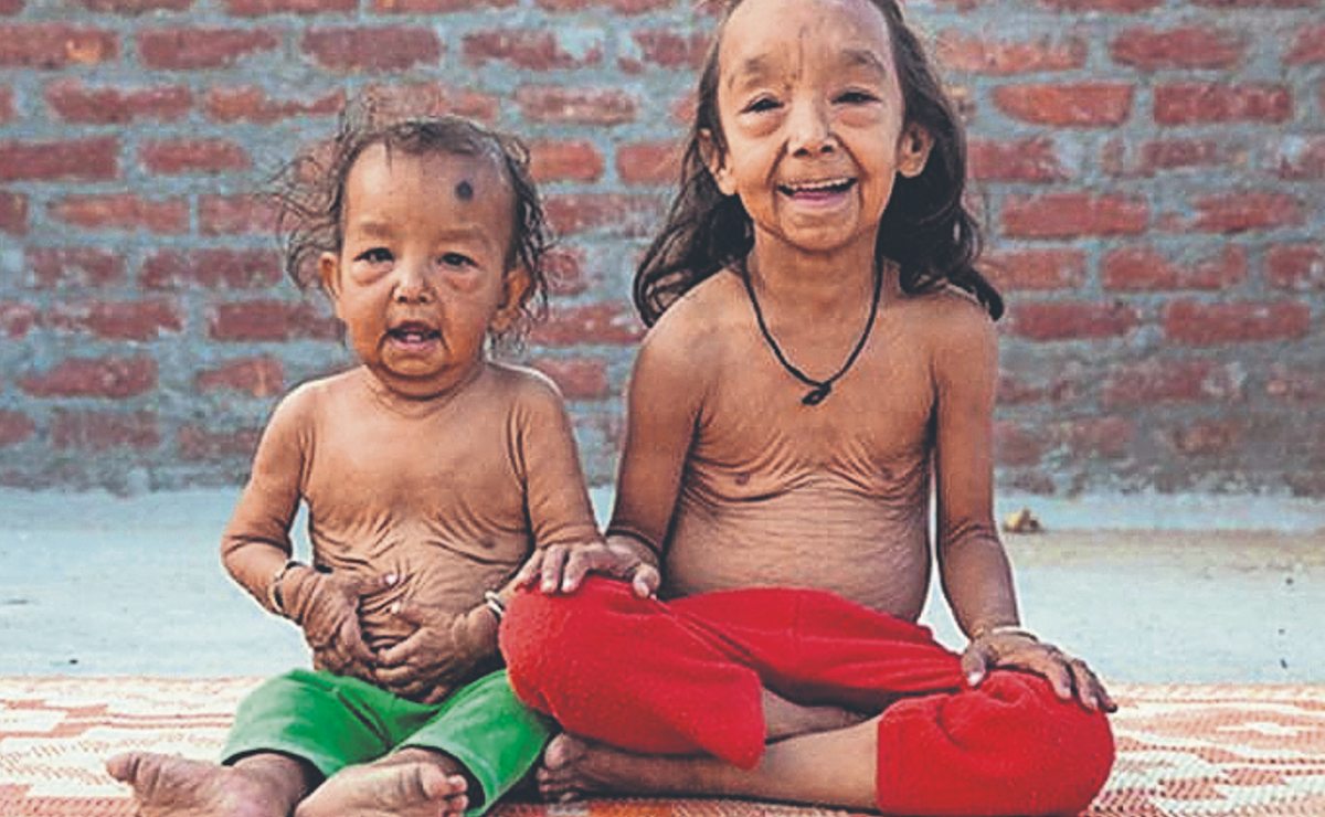Ellos son los “hermanos Benjamin Button”, dos niños que parecen abuelitos por enfermedad