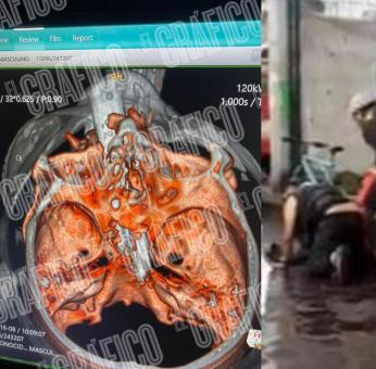 Revelan estado de hombre con cuadraplejia atravesado con palo de escoba en la cara, en Xochimilco