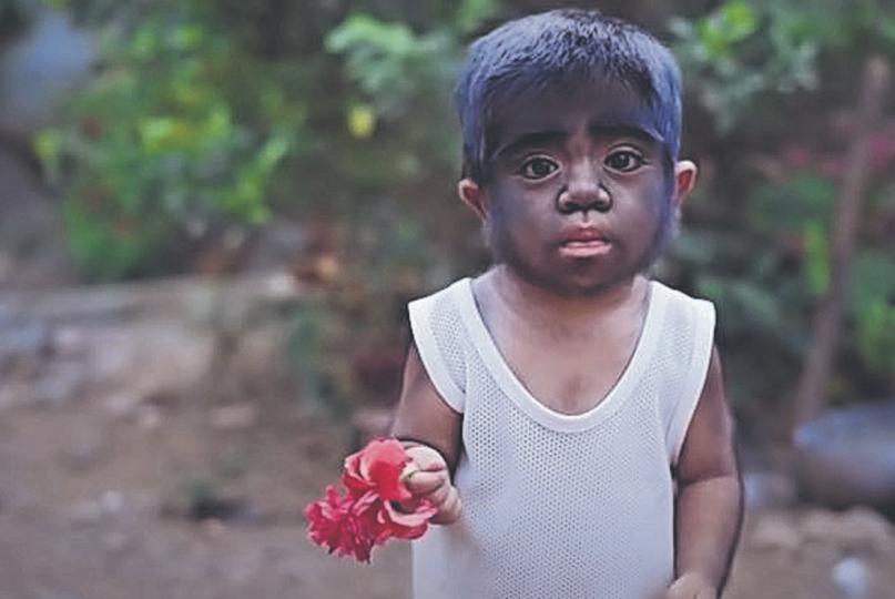 Nació “bebé lobo”, madre cree que es una maldición por algo que hizo durante el embarazo