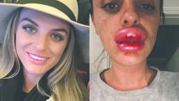 Mujer casi se queda sin labios por inyectarse botox, en Estados Unidos