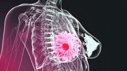 Hallan fármaco que frenaría metástasis de cáncer de mama, en Suiza