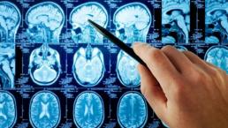 avances científicos crean implante cerebral estimular la memora recuerdos