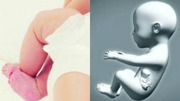 bebe nació embarazada fetus in fetus Colombia