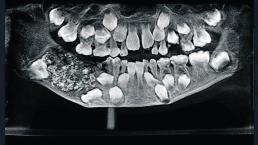 Extraen más de 500 dientes a niño de siete años tendrá que usar prótesis dentales