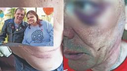Hombre revela brutales golpes e intento de homicidio de esposa alcohólica, aguantó 3 años