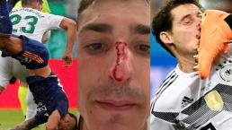 Juan Ignacio Dinenno y otros futbolistas que han sufrido brutales fracturas en la nariz