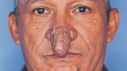 La increíble historia del cirujano plástico que ayudó a un hombre con su nariz