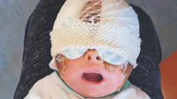 Por extraña condición genética, bebé lucha por su vida al convertirse su piel en caparazón