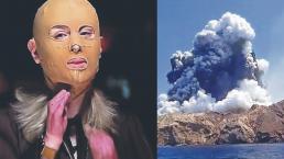 Mujer que sobrevivió a erupción de volcán muestra como quedó su rostro quemado