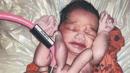Bebé que nació con 4 brazos y 4 piernas es considerado la reencarnación de Dios, en la India