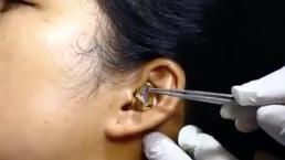 Impacta supuesta extracción de una serpiente dentro del oído de una mujer