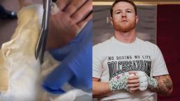 Así quedó la mano del Canelo Álvarez, tras cirugía que lo alejará del ring todo el año