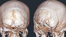 Clavo llega al cerebro de un hombre y este vive para contarlo, en Malasia