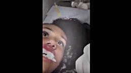 Extirpan gusano vivo en labio de mujer | VIDEO